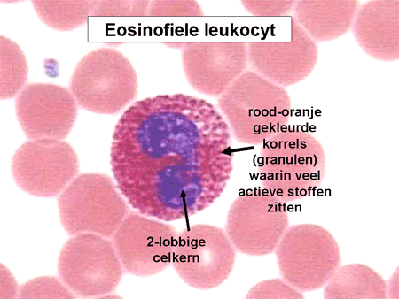 eosinofiel-granuloom-complex